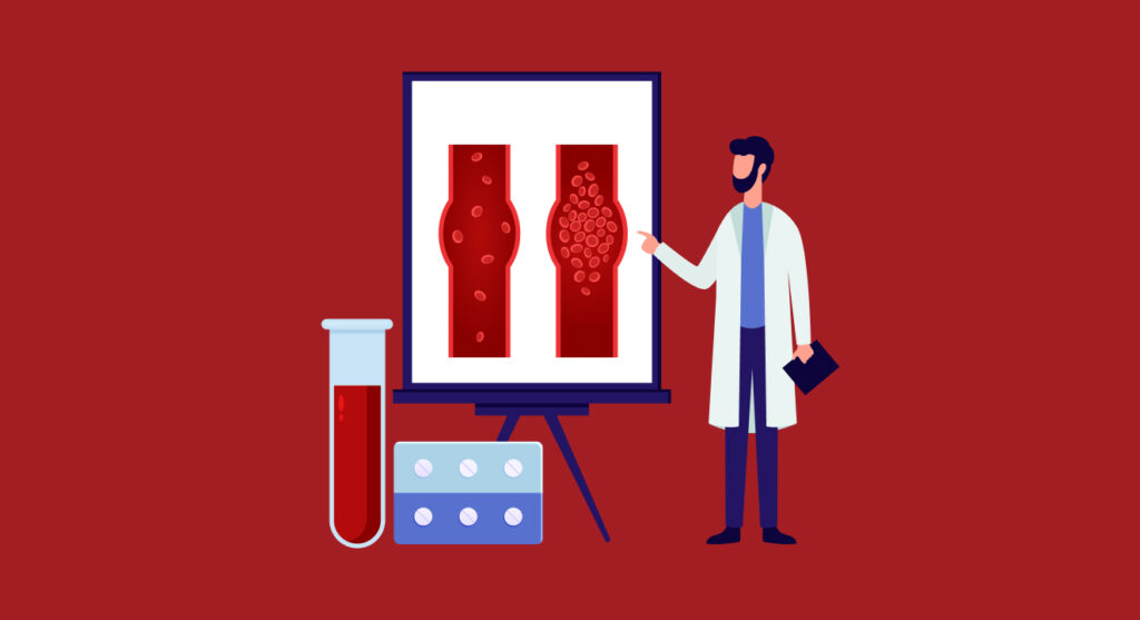 Graphic of a doctor and a diagram of veins with deep vein thrombosis